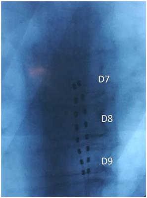 All-in-One Spinal Cord Stimulation in Lymphoproliferative Diseases